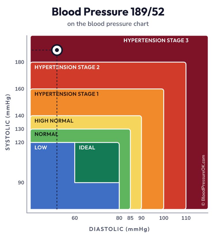 Blood pressure 189 over 52 on the blood pressure chart